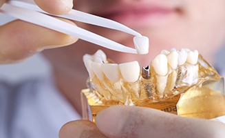 doctor showing dental implant Dental Implant Sydney