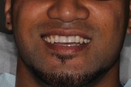 Case04-After