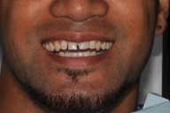 Case04-Before