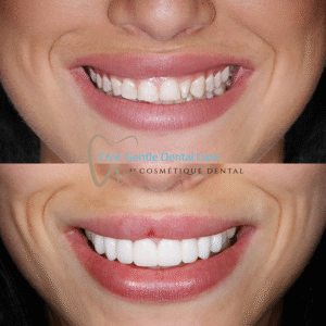 Before and after porcelain veneers showing smile transformation with improved tooth shape, colour, and overall symmetry