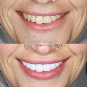 Porcelain veneers before and after treatment highlighting enhanced aesthetics and a more balanced smile