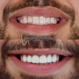Smile makeover with porcelain veneers before and after results demonstrating improved tooth alignment and appearance