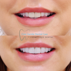 Before and after porcelain veneers treatment showcasing natural-looking cosmetic dental improvements