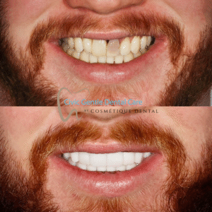 Porcelain veneers transformation displaying the difference between the patient's original smile and final result