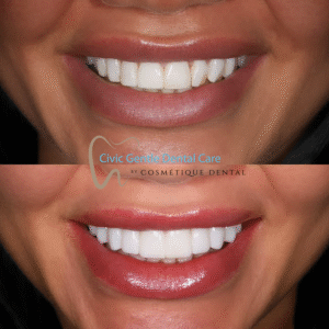 Before and after cosmetic dentistry with porcelain veneers creating a brighter, more harmonious smile