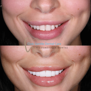 Porcelain veneers before and after photos illustrating enhanced tooth proportions, colour, and smile aesthetics