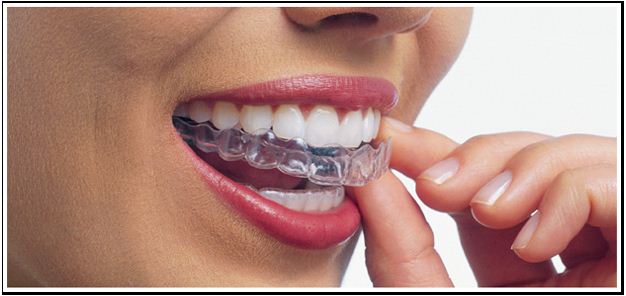 We provide high quality Invisalign in Canberra.