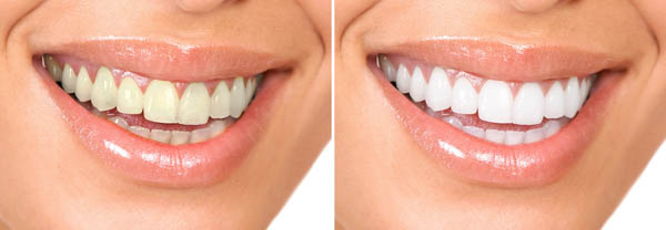 We are the experts of teeth whitening in Canberra.