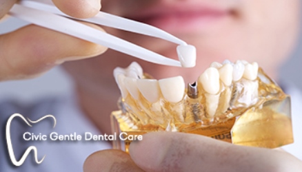 We have the best offer for dental implants in Canberra.