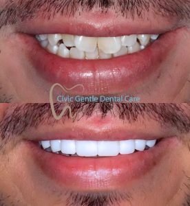 Porcelain Veneers