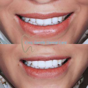 Porcelain Veneers