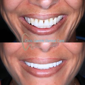 Porcelain Veneers