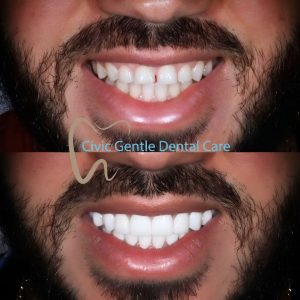 Porcelain Veneers