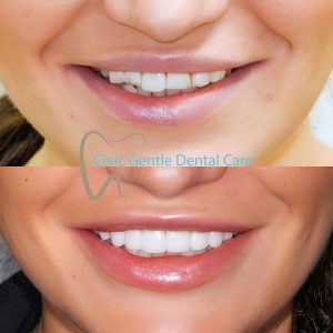 Porcelain Veneers