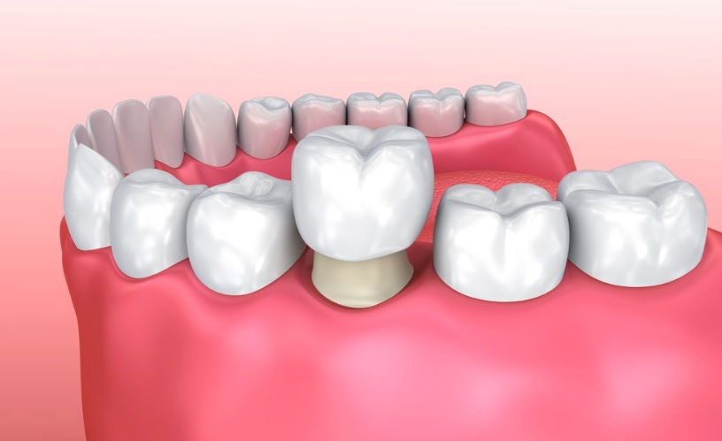 We are the best when it comes to dental crowns here in Canberra.