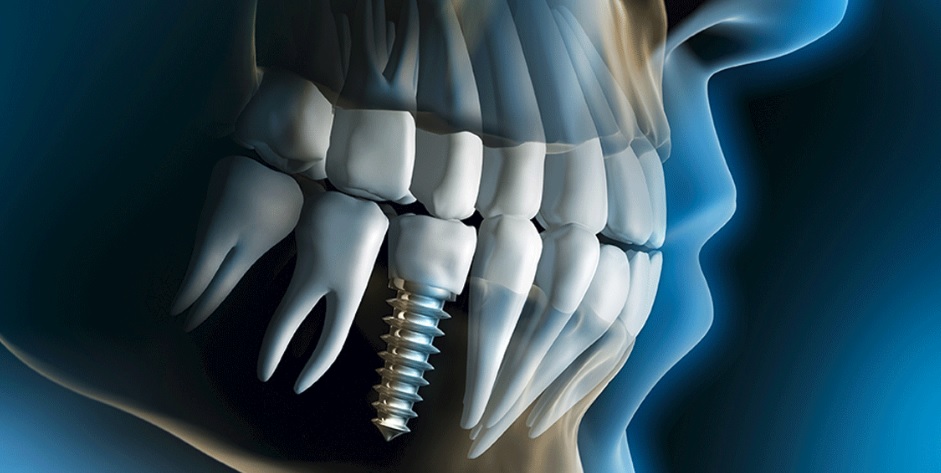 The best dental implant in Canberra