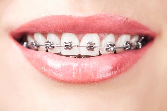 We have the best orthodontist in Canberra