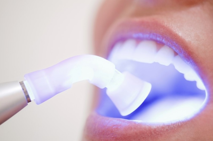 Teeth whitening price