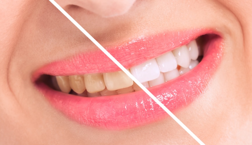 We have the best teeth whitening service in Canberra.