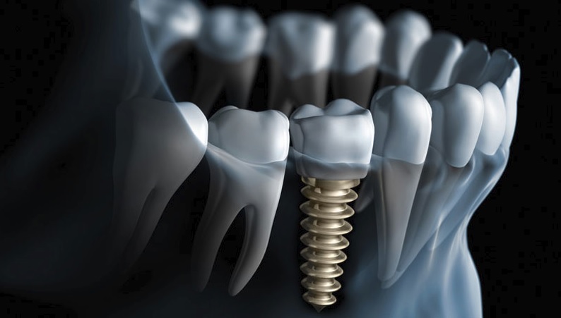 Affordable dental implant in Canberra