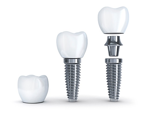 Affordable dental implant in Canberra
