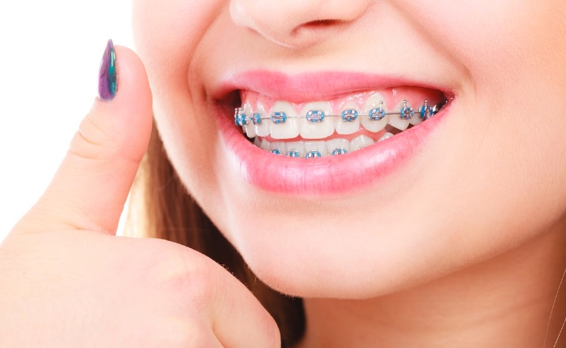 Clear Braces, Ceramic Braces Canberra