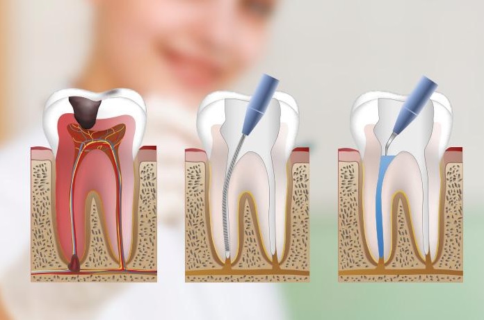 We have the best root canal therapy in Canberra