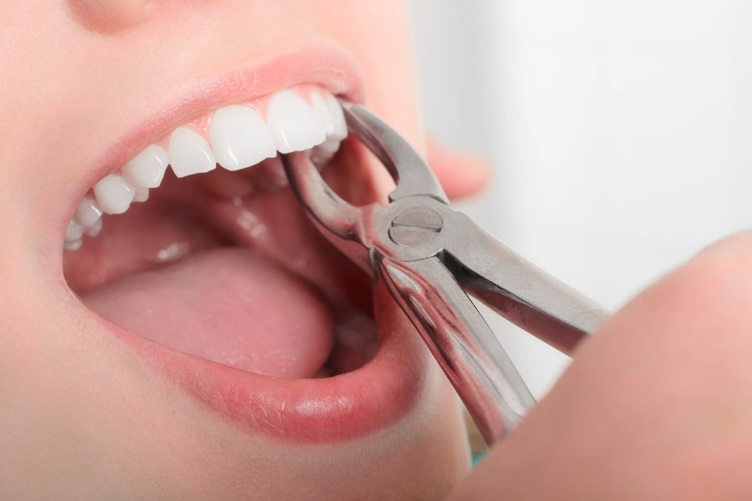 We provide tooth extraction in Canberra.