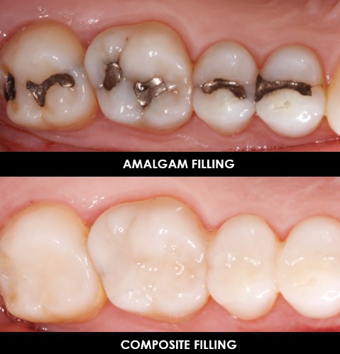 How Much Does a Dental Filling Cost? - Explained