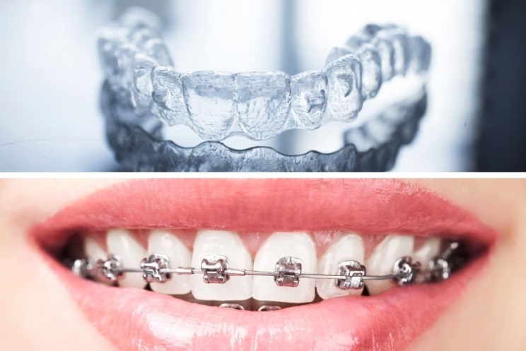 Orthodontics in Canberra