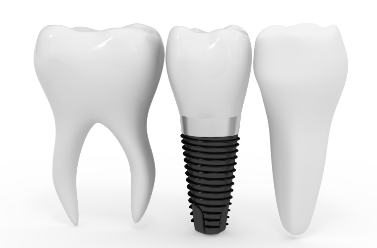 Dental implant cost in Canberra
