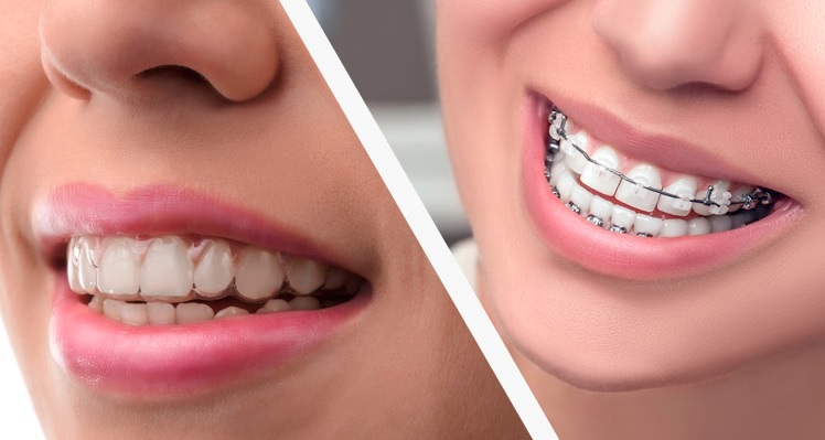 Invisalign Canberra