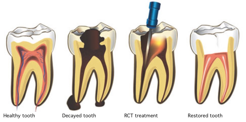 Root canal treatment in Canberra