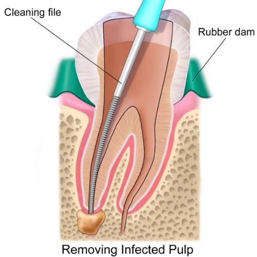 Root canal treatment in Canberra