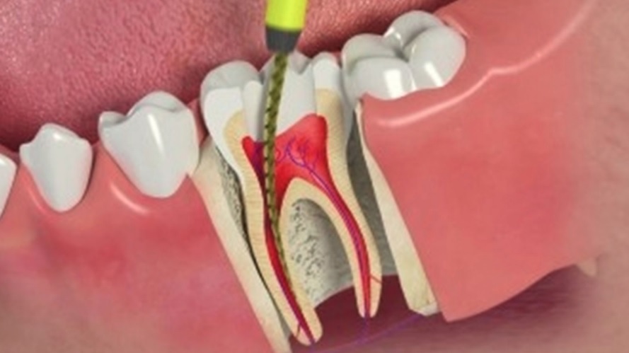 Root canal treatment cost in Canberra