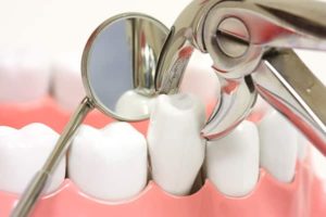 Tooth Removal in Canberra