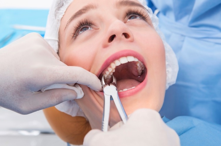 Tooth Removal in Canberra