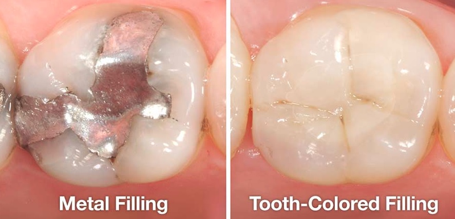 Dental Fillings in Canberra