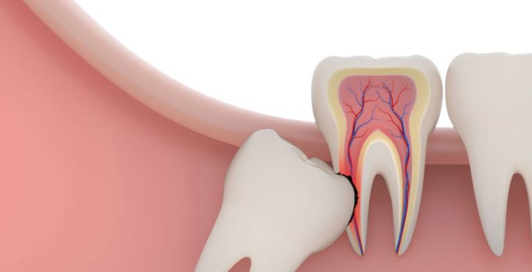 Wisdom Teeth Removal and Medicare Coverage Dentist Canberra