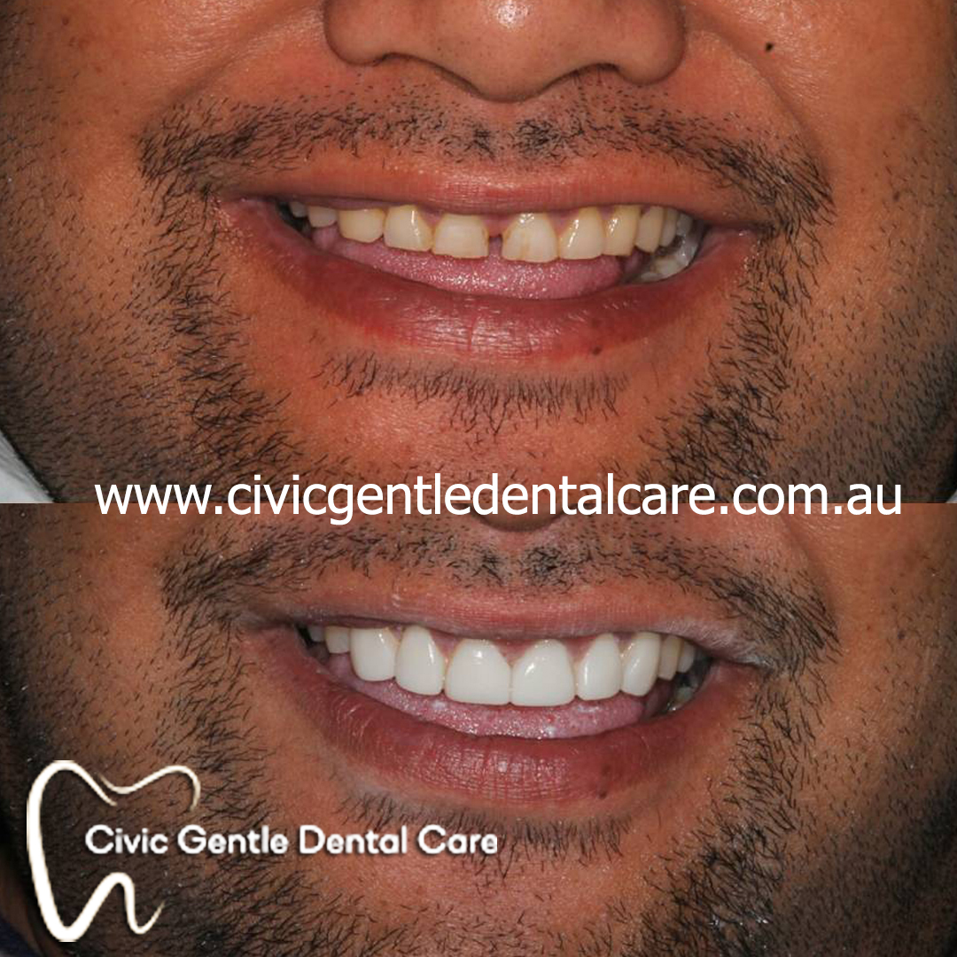 Cosmetic Dentistry cost in Canberra