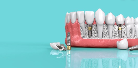 durability of dental implants in Canberra