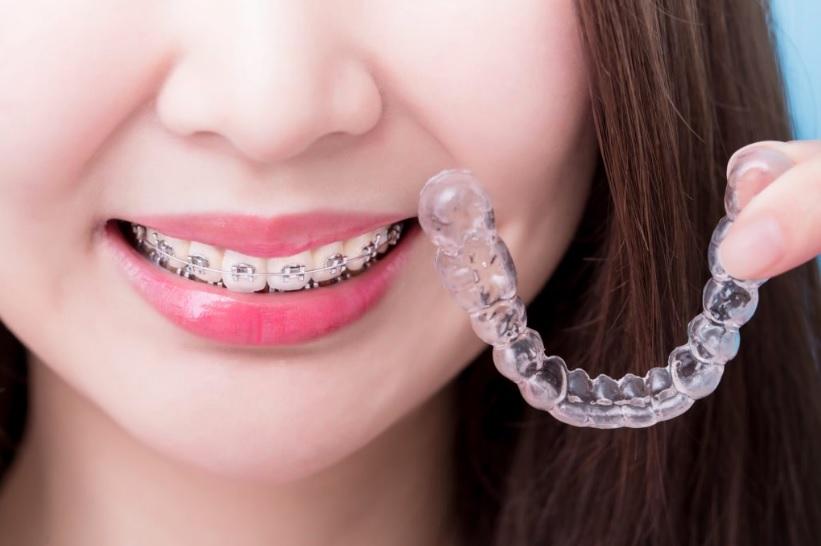 Types of braces in Canberra