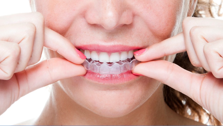 cost of invisalign in Canberra