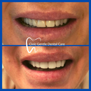 Dental Veneers Canberra