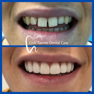 Dental Veneers by Dr Tam Le here in Canberra