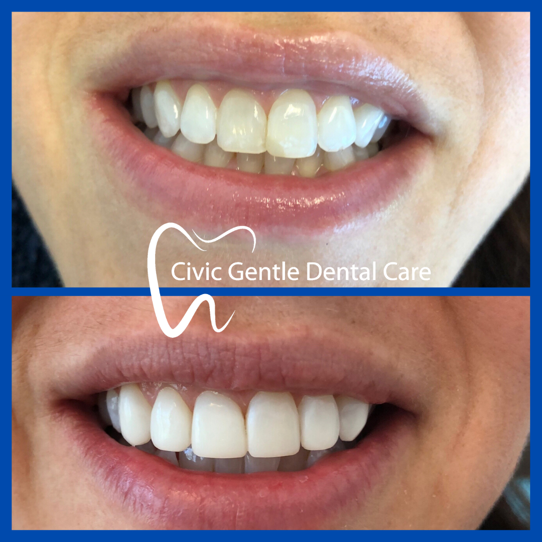 Smile Transformation by Dr Tam Le here in Civic Gentle Dental Care at Canberra