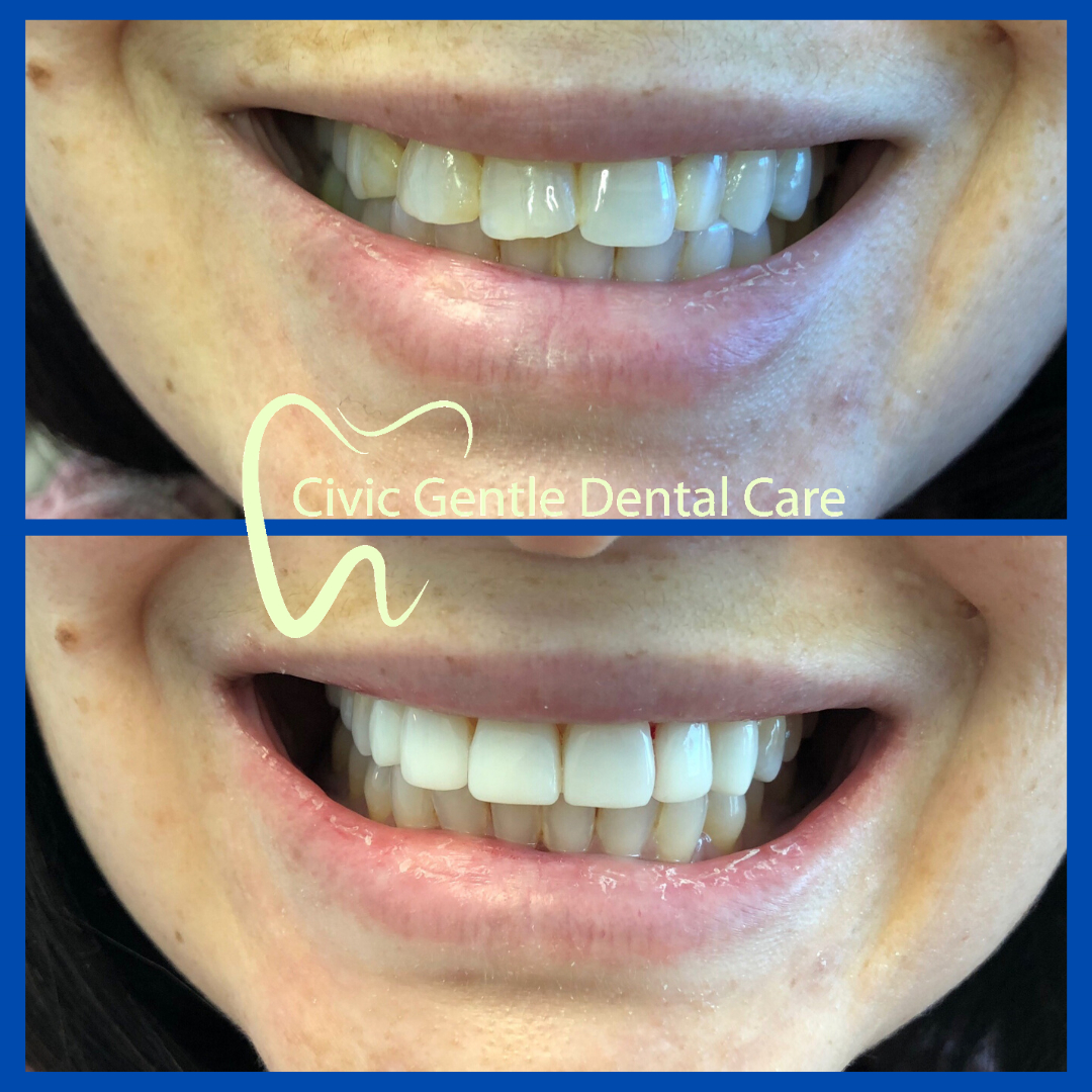 Veneers by Dr Tam Le here in Civic Gentle Dental Care at Canberra