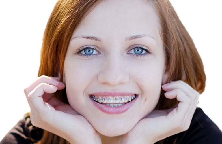 Best Braces For Teeth