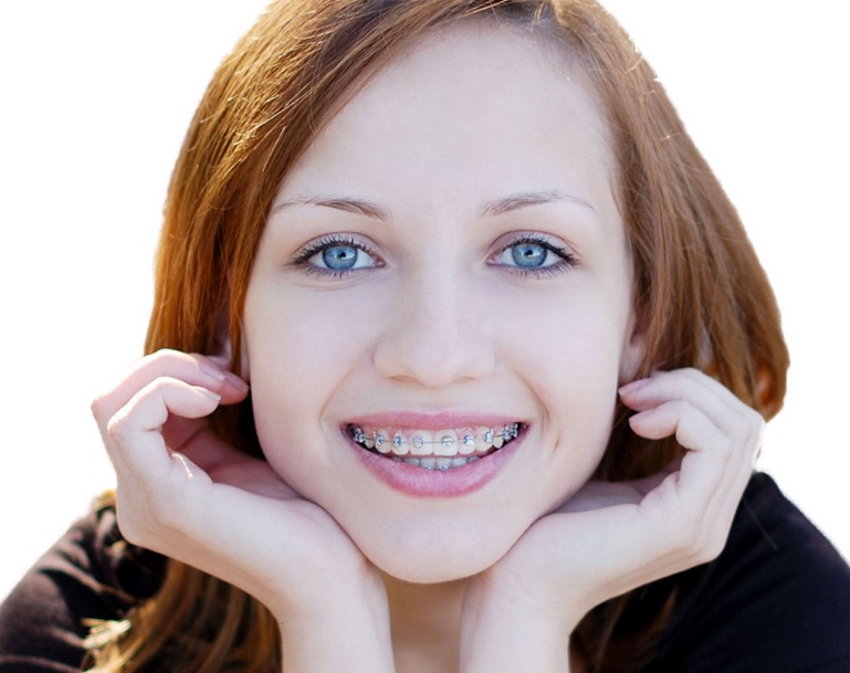 Best Braces For Teeth