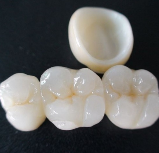 Tooth Crown Cost